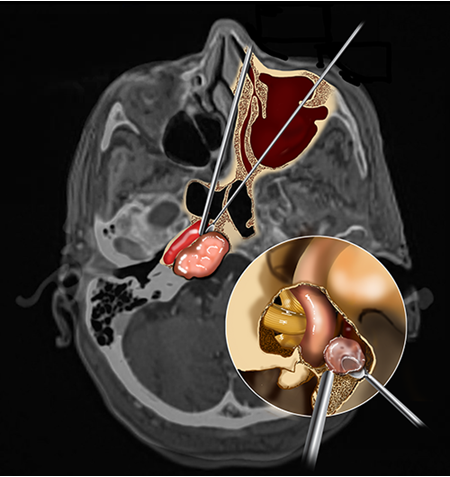 Resection of a chondrosarcoma near the internal carotid artery achieved by combined endonasal and transmaxillary surgical approaches.
